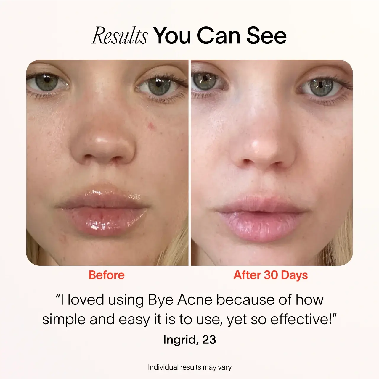 Bye Acne 3 Minute Pimple Spot Treatment Blue Light Therapy