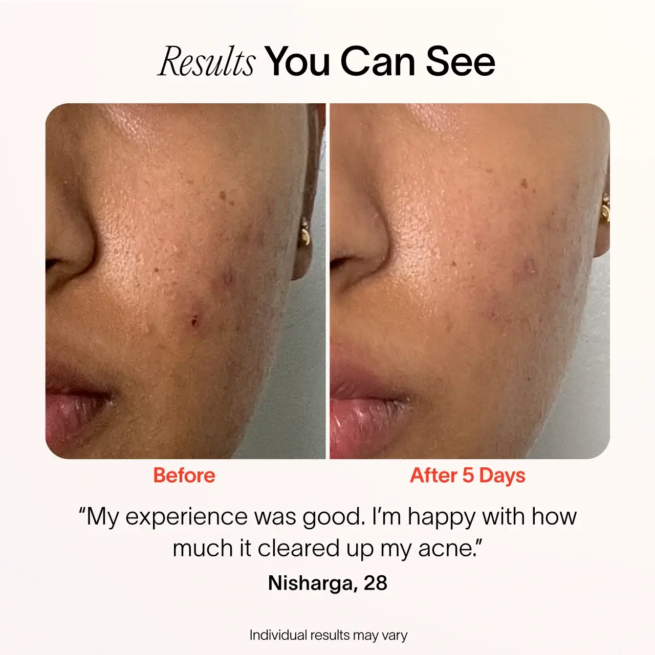 Bye Acne 3 Minute Pimple Spot Treatment Blue Light Therapy